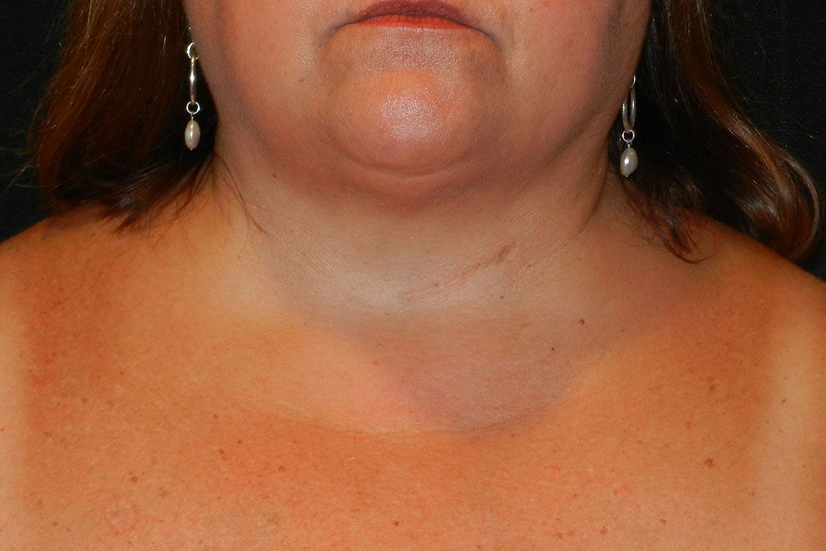 Facial Procedure Gallery #1 After – North Charleston, SC – Palmetto Plastic Surgery