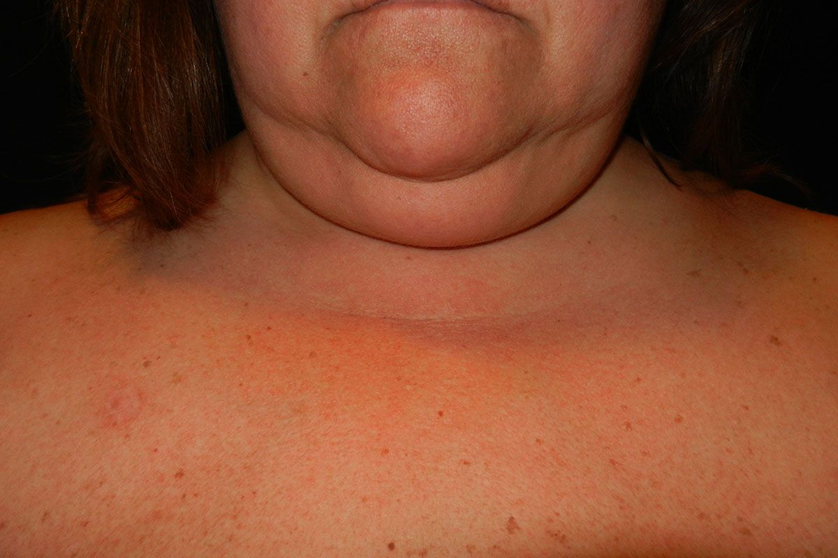Facial Procedure Gallery #1 Before – North Charleston, SC – Palmetto Plastic Surgery