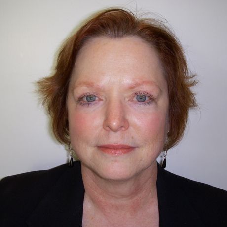 Facial Procedure Gallery #5 After – North Charleston, SC – Palmetto Plastic Surgery