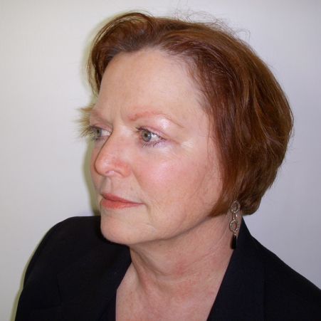 Facial Procedure Gallery #6 After – North Charleston, SC – Palmetto Plastic Surgery
