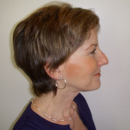 Facial Procedure Gallery #8 After – North Charleston, SC – Palmetto Plastic Surgery