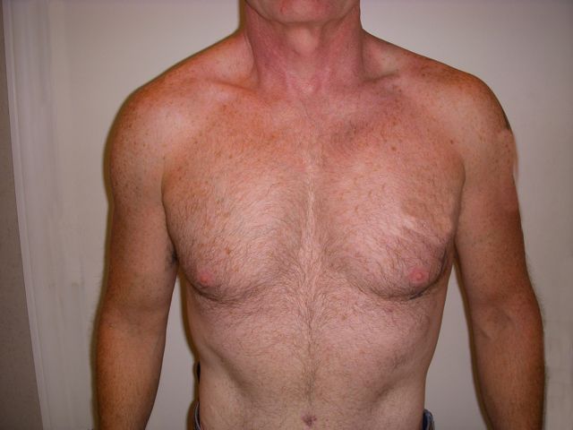 Body Procedure Gallery #6 After – North Charleston, SC – Palmetto Plastic Surgery