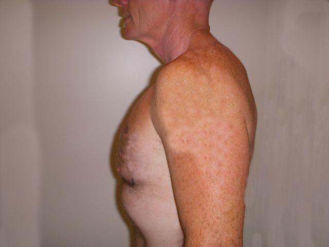 Body Procedure Gallery #7 After – North Charleston, SC – Palmetto Plastic Surgery