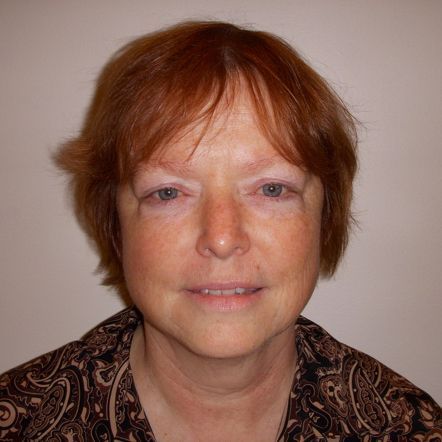 Facial Procedure Gallery #5 Before – North Charleston, SC – Palmetto Plastic Surgery