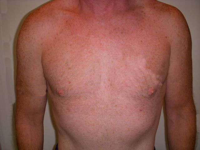 Body Procedure Gallery #6 Before – North Charleston, SC – Palmetto Plastic Surgery