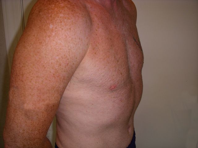 Body Procedure Gallery #7 Before – North Charleston, SC – Palmetto Plastic Surgery