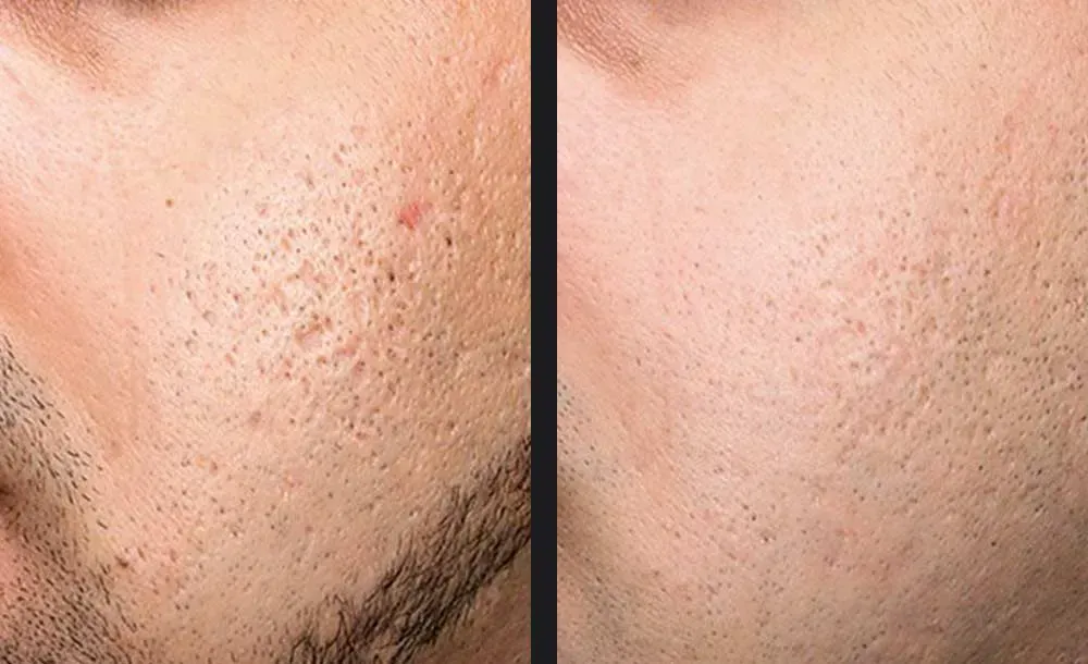 Microneedling treatment for Acne