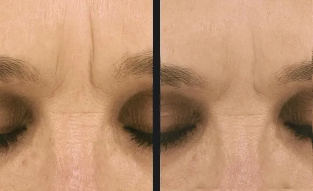 Microneedling treatment for wrinkles