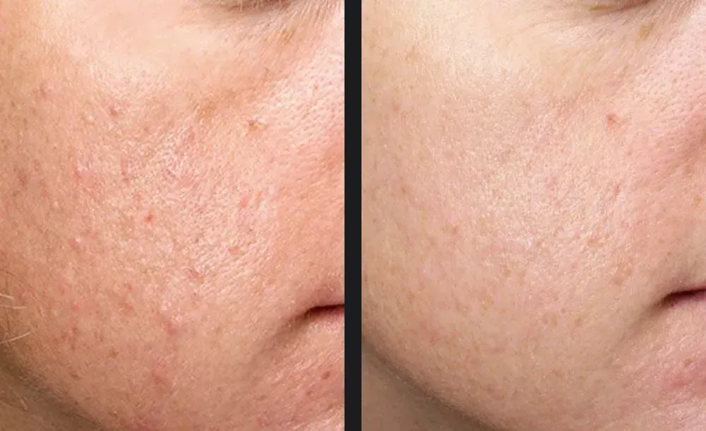 Microneedling treatment for Acne