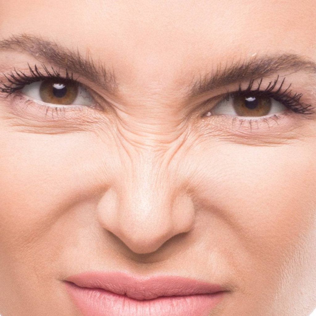 Bunny lines wrinkle relaxer treatment area