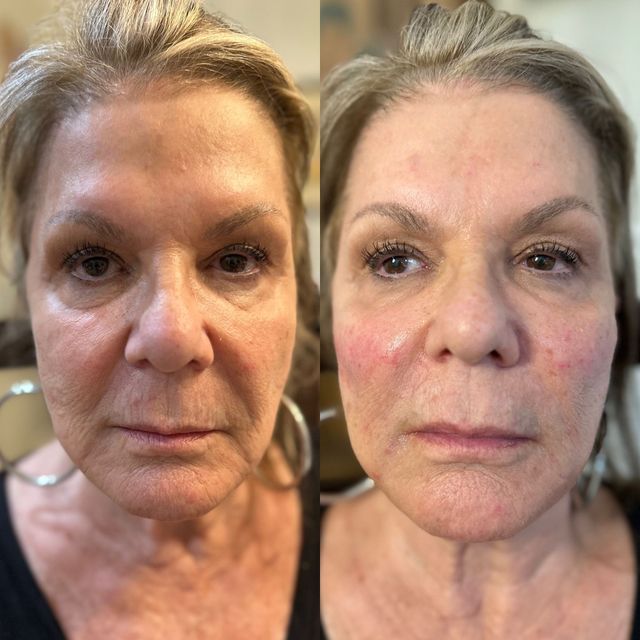 Botox & Filler Benefits in Boca Raton