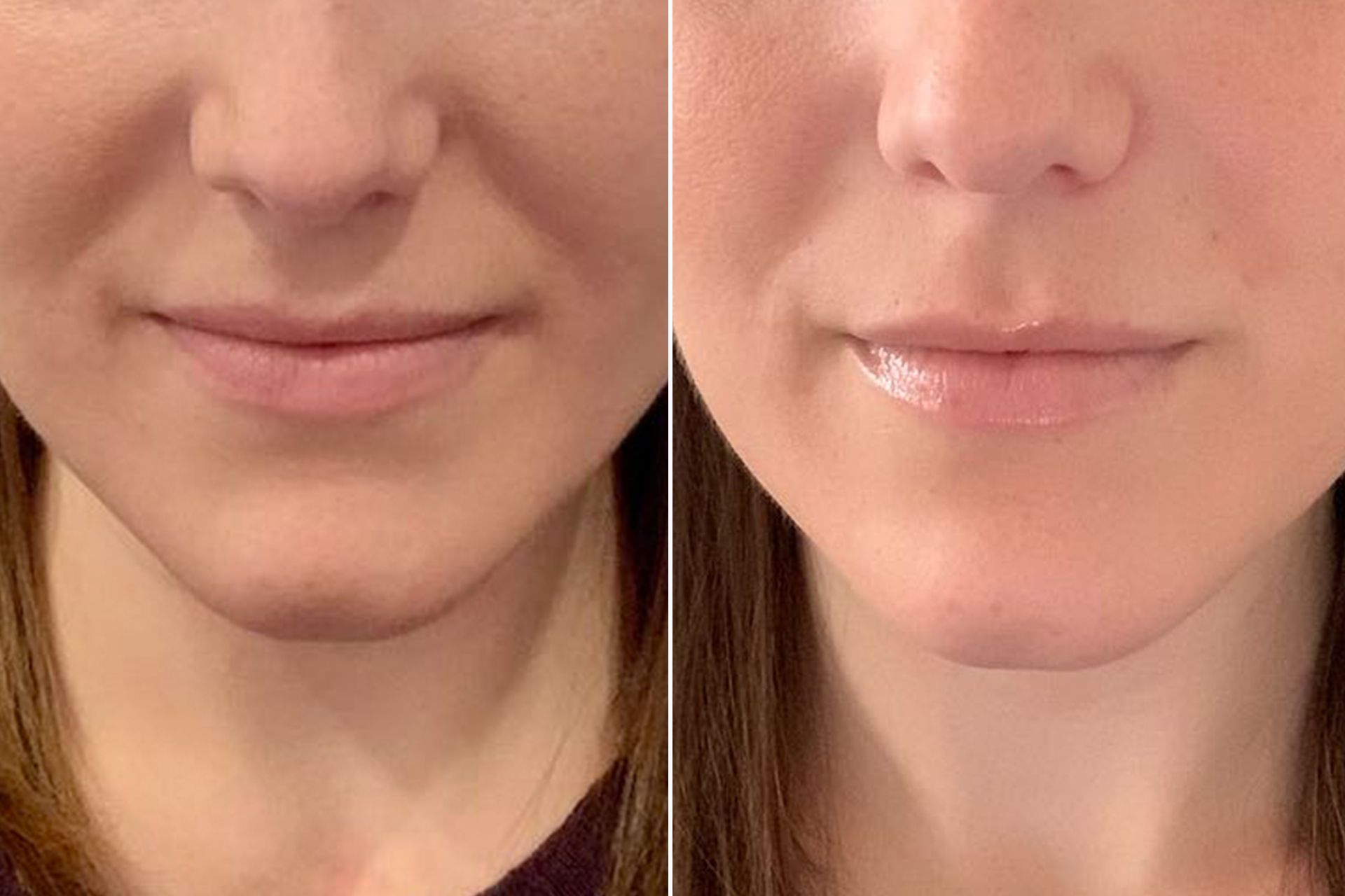 Nasolabial folds before and after