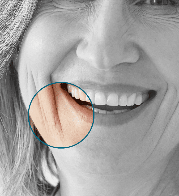 Marionette Smile lines treatment area