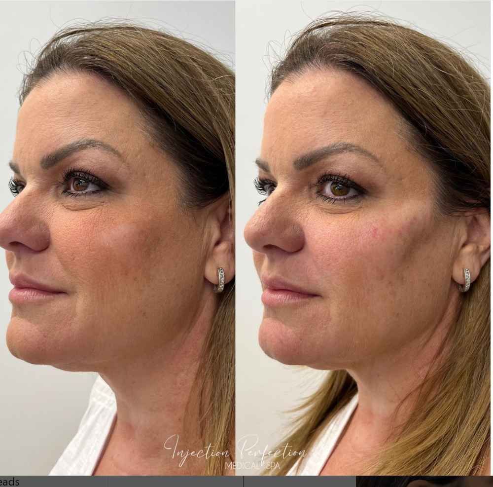 Cheek Filler before and after