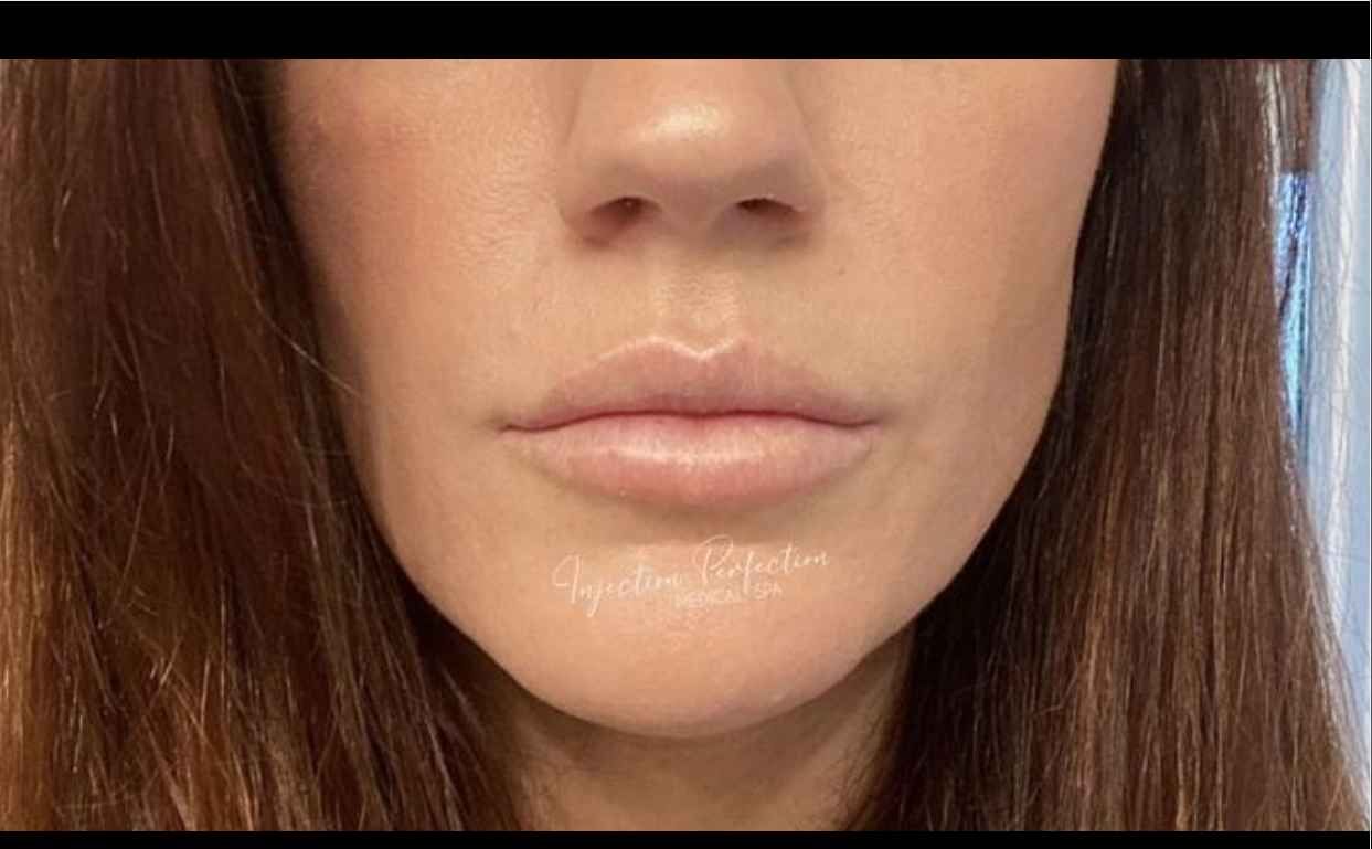 Lip filler after treatment