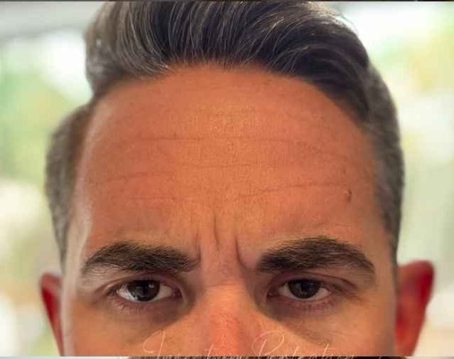 Bro Tox forehead before and after