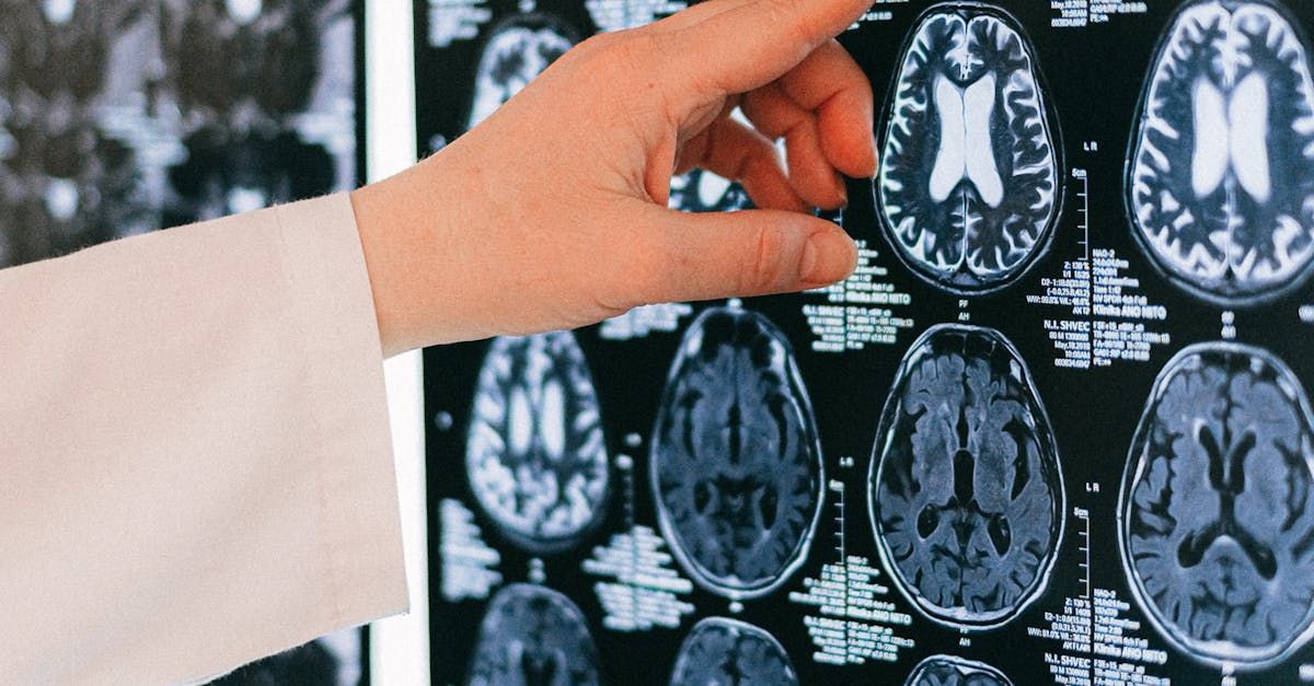 Hand in white sleeve pointing at brain MRI scans on a lightbox