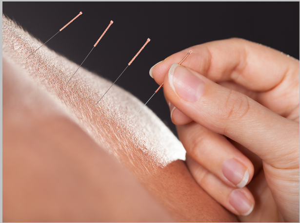 Acupuncture for returning patients in St. Petersburg