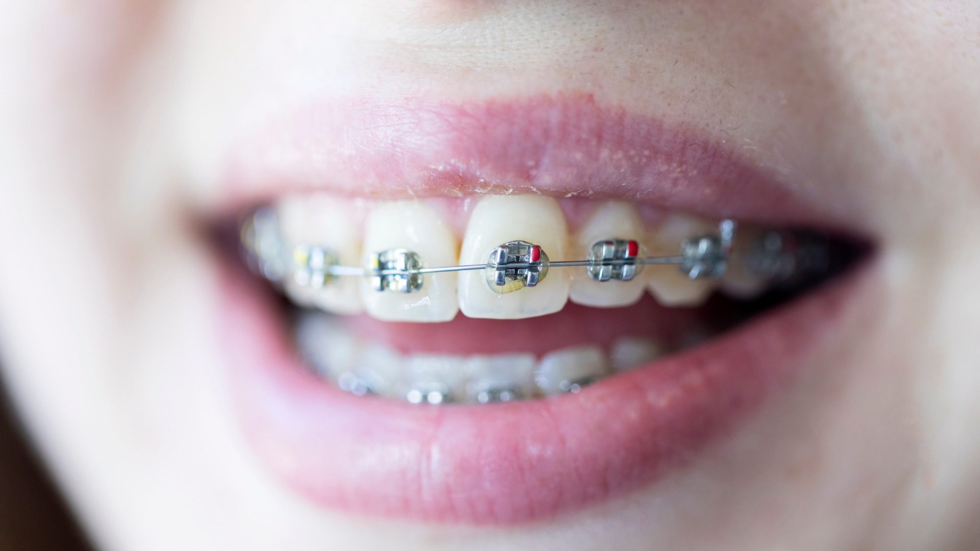 Close-up of smiling mouth with braces and colored elastic bands on teeth