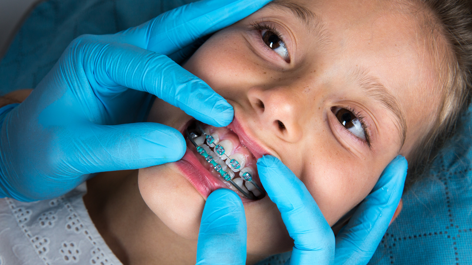 Gloved hands adjusting a clear dental retainer on a child’s teeth