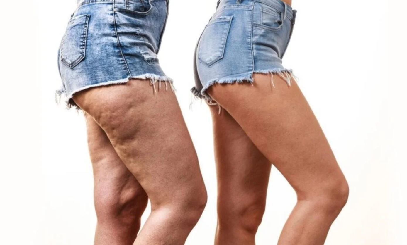 lipedema e alimentação nutricionista Inês Tomada