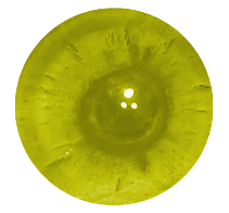 Posterior Subcapsular Cataracts