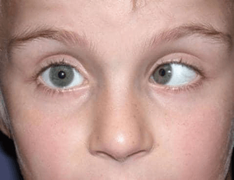 Strabismus