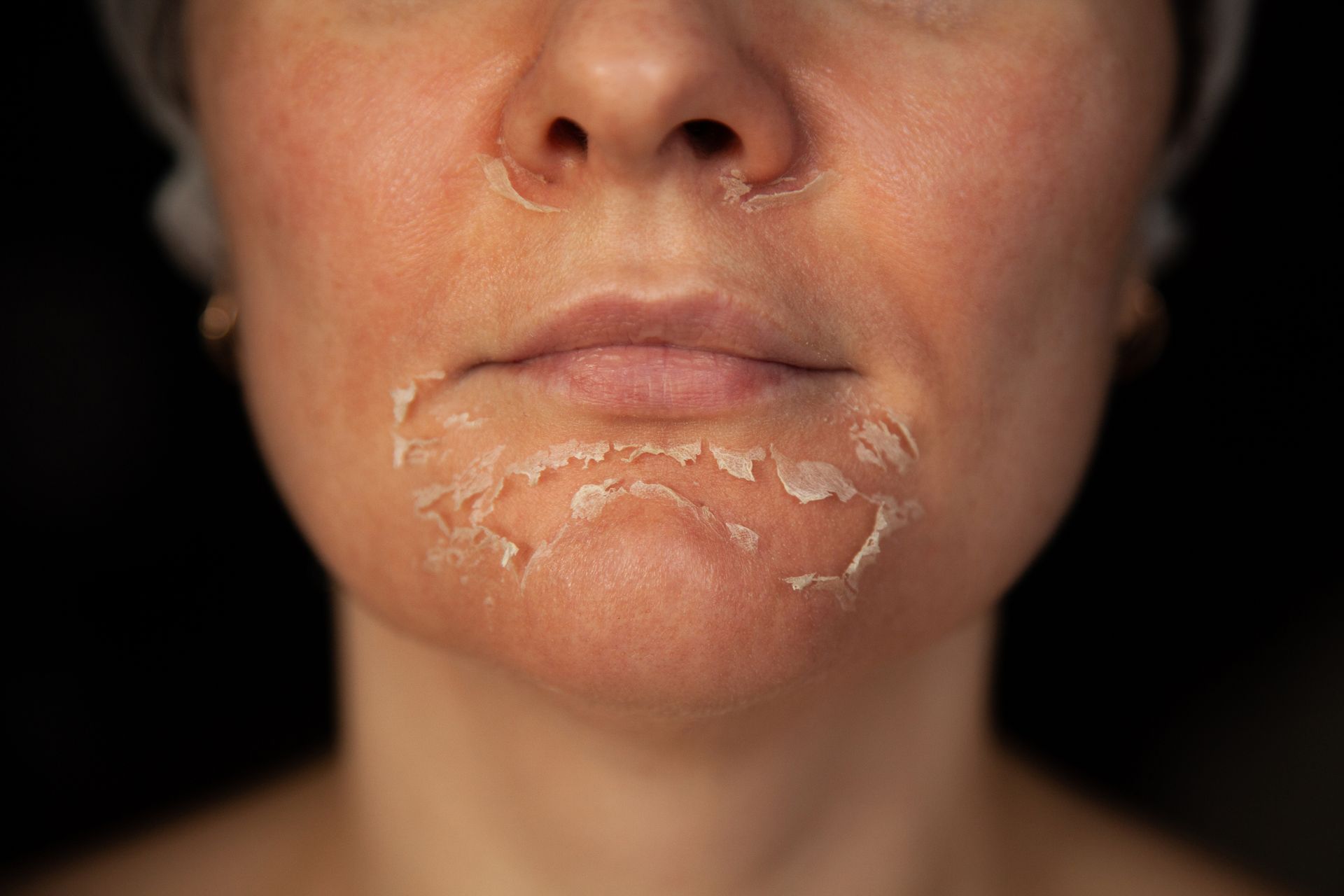 chemical peel