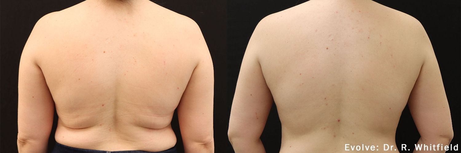 EvolveX Transform Before and After