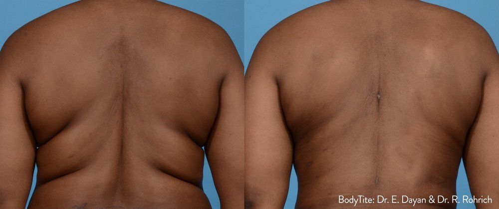 BodyTite before and after 1