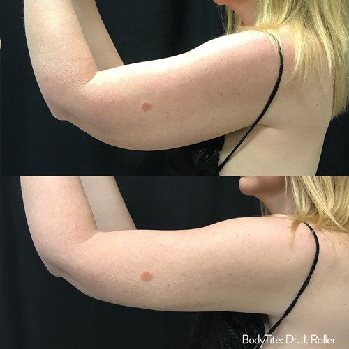 BodyTite before and after 3
