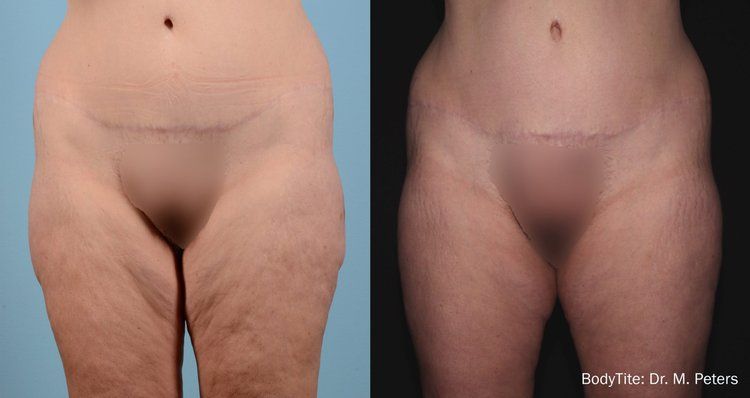 BodyTite before and after 4