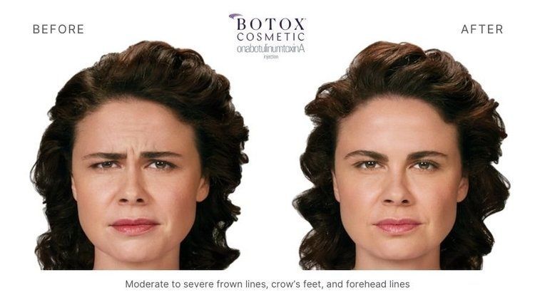 botox before and after 1