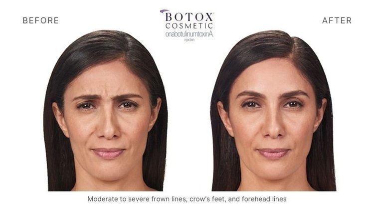 botox before and after 2
