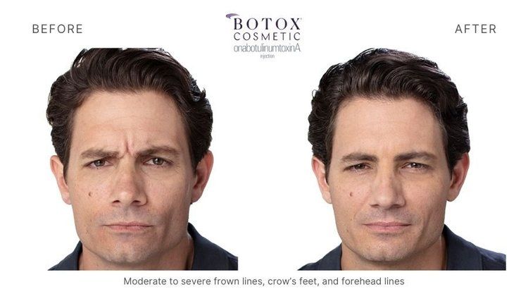 botox before and after 3
