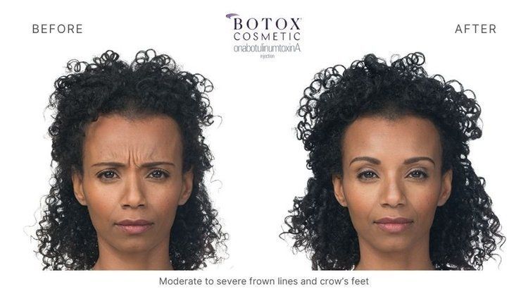 botox before and after 4
