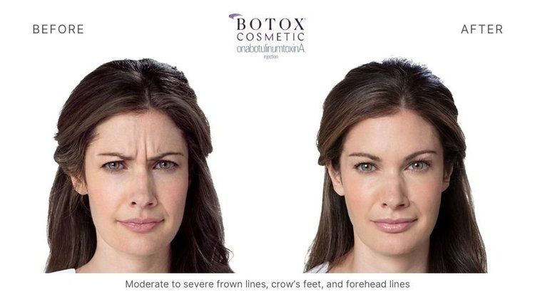 botox before and after 5