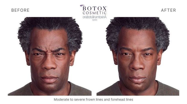 botox before and after 6