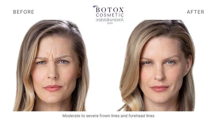 botox before and after 7