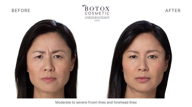 botox before and after 8