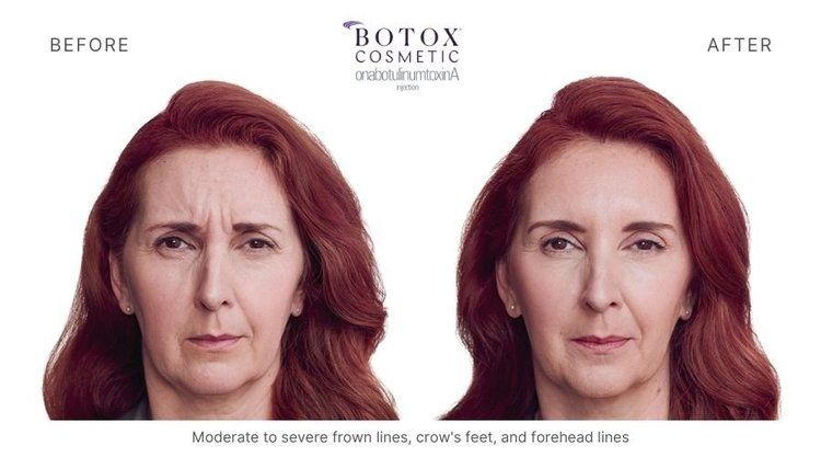 botox before and after 9
