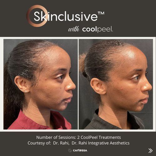 cool peel 1