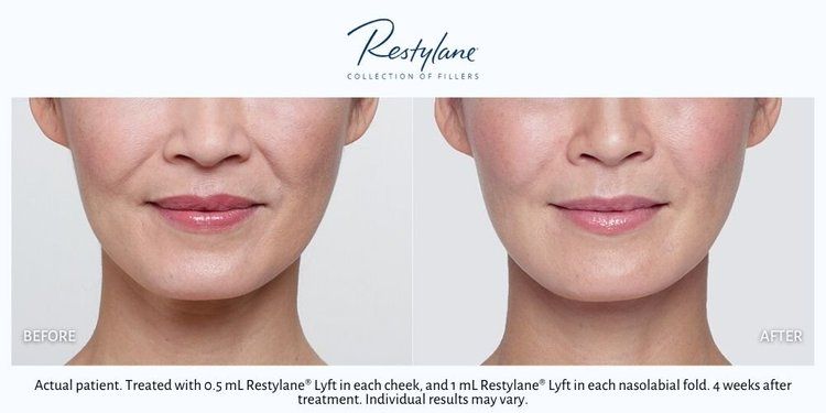 Dermal Fillers 1