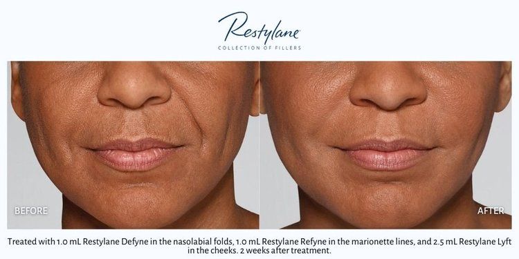 Dermal Fillers 2