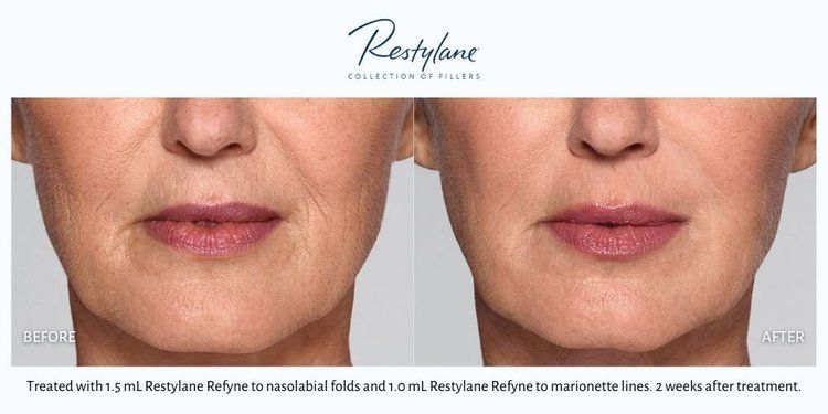 Dermal Fillers 3