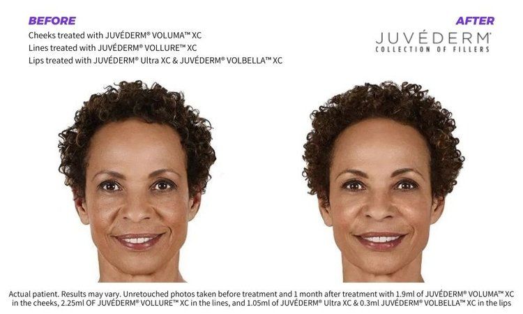 Dermal Fillers 4