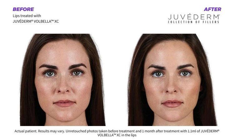 Dermal Fillers 5