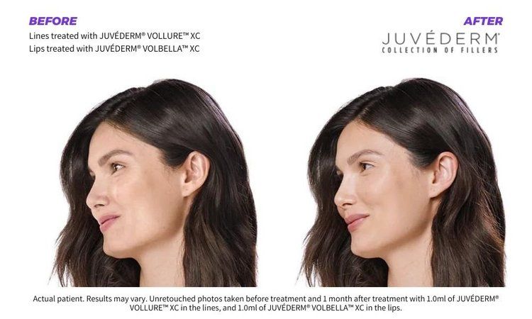 Dermal Fillers 6