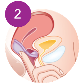Inserting Caya Diaphragm