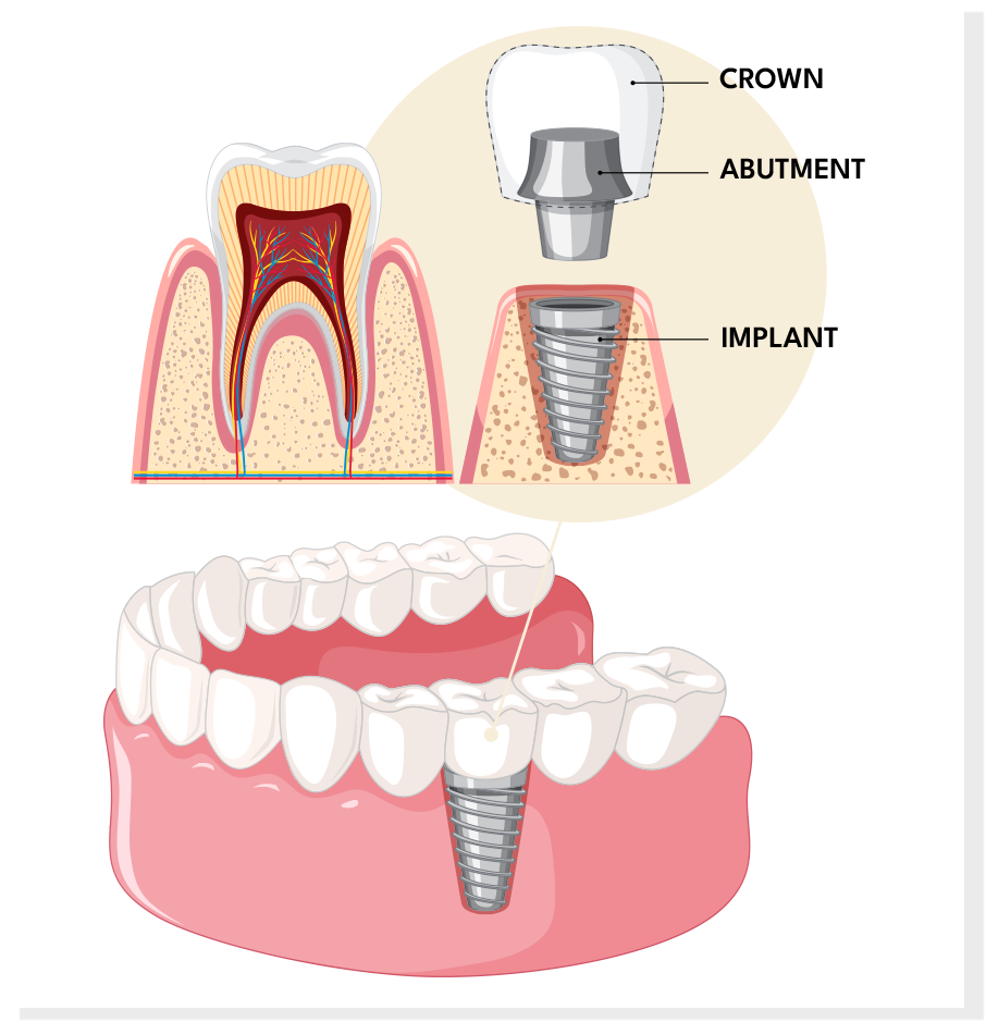 a diagram about dental implants at the smile suite in colorado